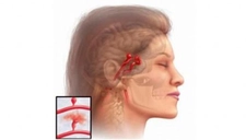 Beyin Kanaması Sonrası Tedavi