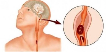 Beyin Sapı Kanaması Belirtileri ve Tedavisi