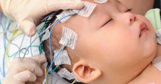 Bebeklerde Beyin Kanaması Belirtileri ve Tedavisi