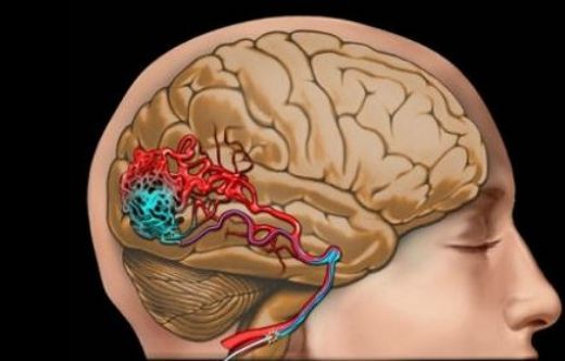 Beyin Kanaması Belirtileri ve Tedavisi