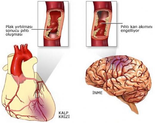 Beyin Kanaması Anevrizma Belirtileri ve Tedavisi