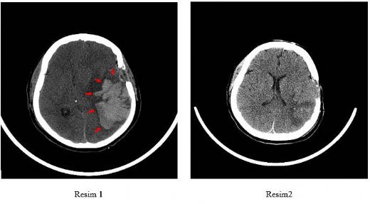 Beyin Kanaması Tomografi