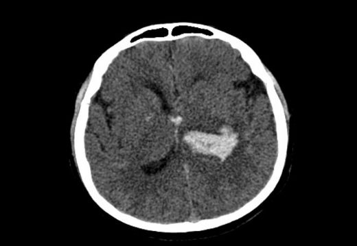 Hipertansiyona Bağlı Beyin Kanaması Belirtileri ve Tedavisi